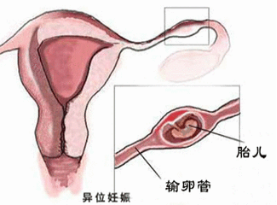 宫外孕并发症有哪些？
