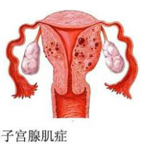 子宫腺肌症的注意事项？